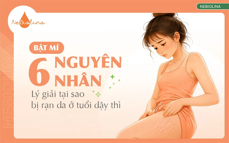 tại sao bị rạn da ở tuổi dậy thì (1)